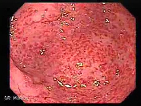 Gastric Antral Vascular Ectasias - GAVE (1 of 6)