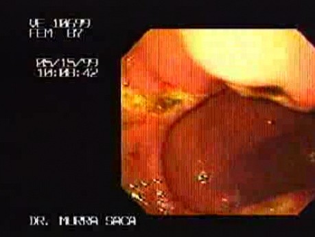 Multiple Gastric Ulcers (2 of 2)
