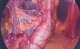 Remodeling of recurrent terminal ostomy prolapse