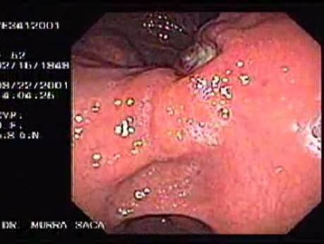 Ulcerated Gastric Adenocarcinoma (1 of 2)
