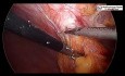 Laparoscopic Repair of Subcostal Incisional Hernia