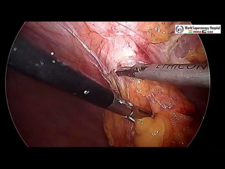 Laparoscopic Repair of Subcostal Incisional Hernia