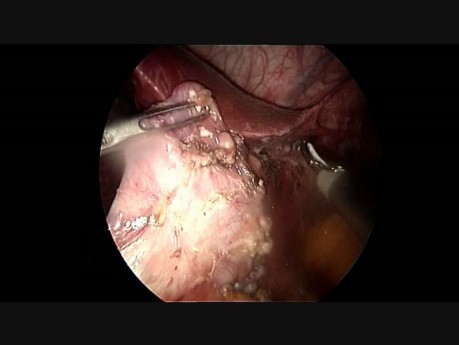 Sleeve Gastrectomy for Gastric Banding Failure
