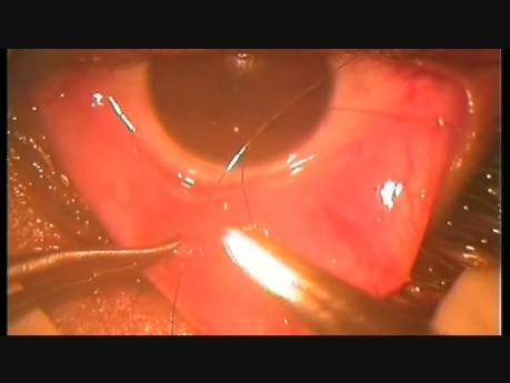 Singh Muller Muscle Plication for Slight/Modest Ptosis, by Orbital Approach