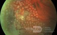 Retinal Laser Photocoagulation in Coats' Disease