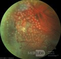 Retinal Laser Photocoagulation in Coats' Disease