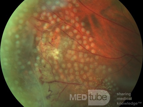 Retinal Laser Photocoagulation in Coats' Disease