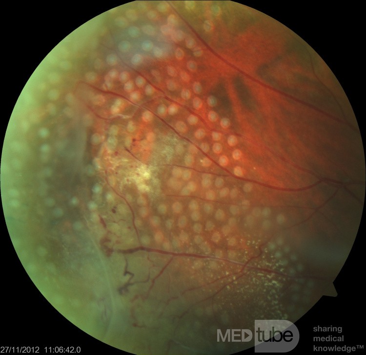 Retinal Laser Photocoagulation in Coats' Disease