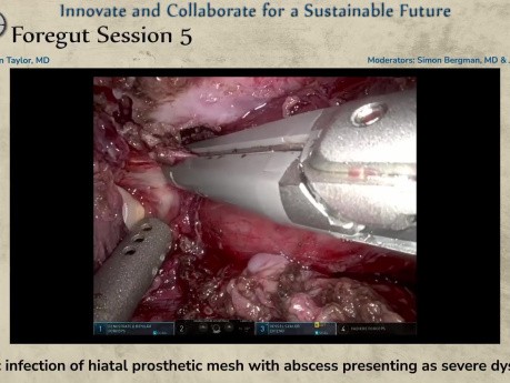 Chronic Infection of Hiatal Prosthetic Mesh with Abscess Presenting as Severe Dysphagia