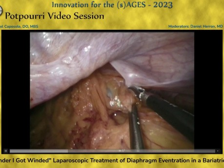 "No Wonder I Got Winded" Laparoscopic Treatment of Diaphragm Eventration in a Bariatric Patient