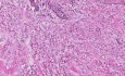 Lobular carcinoma - Histopathology - Breast