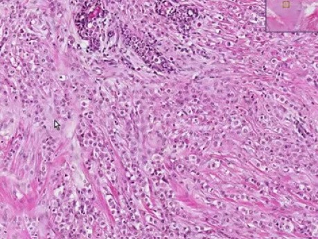 Lobular carcinoma - Histopathology - Breast