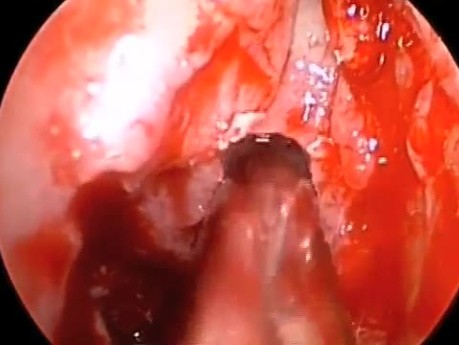 Resection of Haller Cell and Concha Bullosa