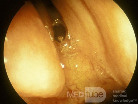 The Sphenoethmoidal Recess [right]