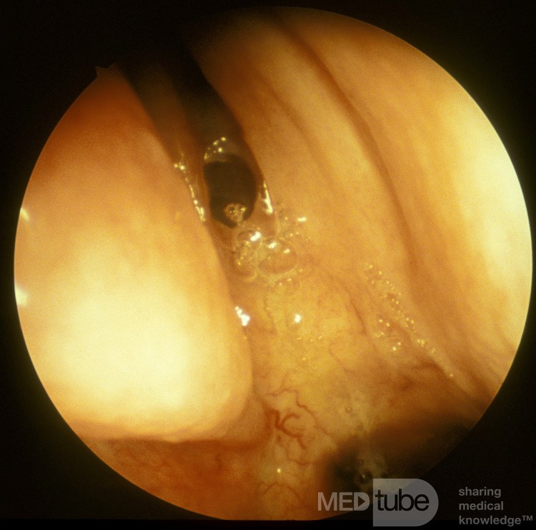 The Sphenoethmoidal Recess [right]