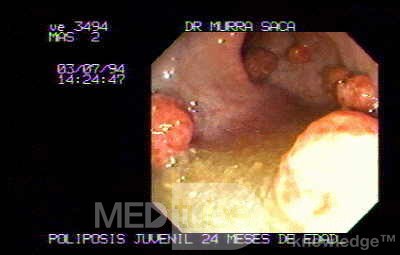 Non Familial Juvenile Polyposis Of The Colon (1 of 37)
