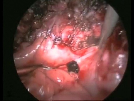 How Important Is Suturing in Dealing With Complications Caused by Laparoscopic Surgery?