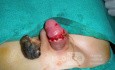 Penis Injury  Necrotic Tissue Removed