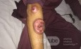 Trouble Some Lesions 
