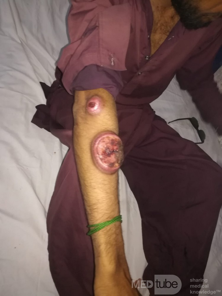 Trouble Some Lesions 