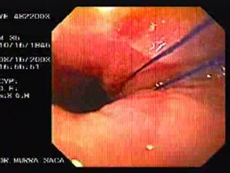 Flexible Endoscopic Suturing - Visualization of Threads
