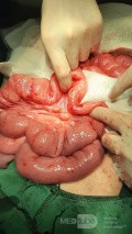 Incomplete Jejunoileal Junction Atresia Chronic Midgut Volvulus