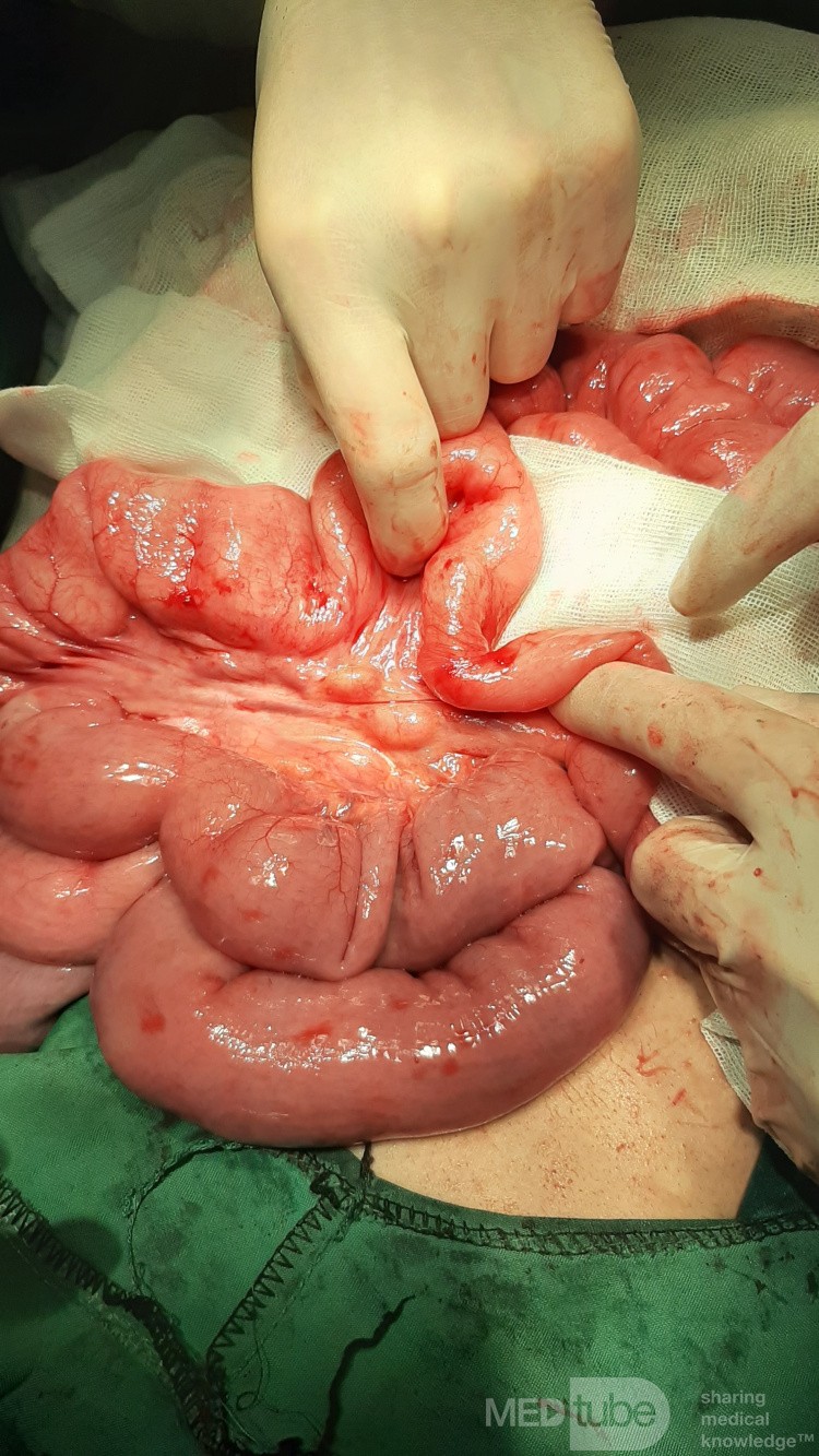 Incomplete Jejunoileal Junction Atresia Chronic Midgut Volvulus