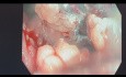 EMR Rectal Polyp In Retroflexion