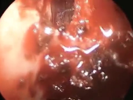 Leak of Cerebrospinal Fluid through Cribriform Plate of Ethmoid and Repair of Defect
