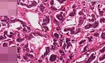 Bronchial carcinoid - Histopathology - Lung