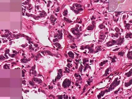 Bronchial carcinoid - Histopathology - Lung