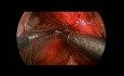 Laparoscopic Partial Posterior Toupet Fundoplication