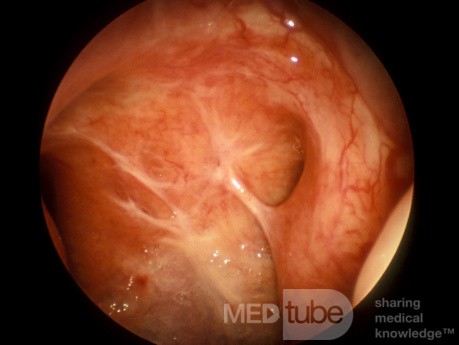 Post Adenoidectomy Scarring of the Nasopharynx Causing Autophonia