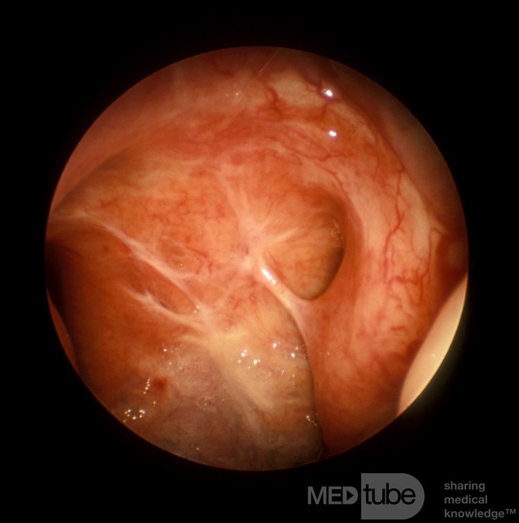 Post Adenoidectomy Scarring of the Nasopharynx Causing Autophonia