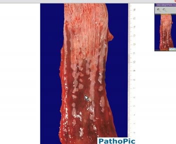 Barrett Esophagus