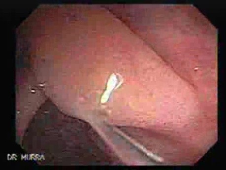 Malign Polyp - 80 year-old lady (1 of 8)