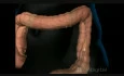 Colonoscopy