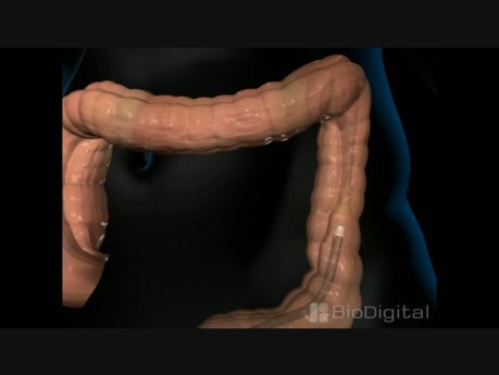 Colonoscopy