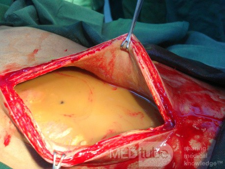 Perforated colonic cancer