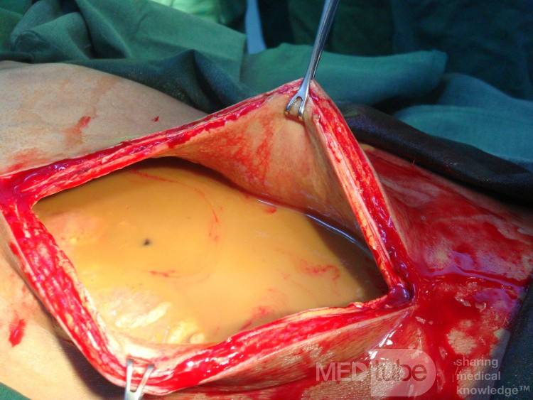 Perforated colonic cancer