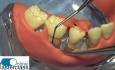 Step by Step Periodontal Regenerative Surgery with Biologically Active Gel and Papilla Preservation