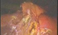 Laparoscopic Cholecystectomy - Part 2
