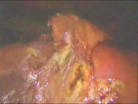 Laparoscopic Cholecystectomy - Part 2