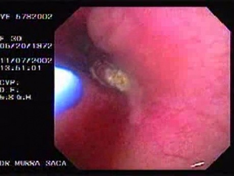 Evolution of a Gastric Carcinoma without a Treatment (7 of 10)