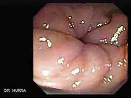 Cap polyposis that resemble a adenocarcinoma of the rectum (7 of 7)