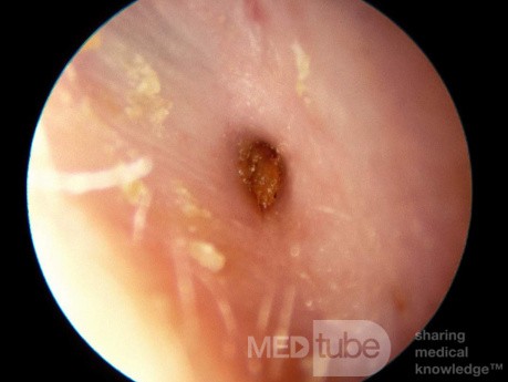 Severe Stenosis of the External Auditory Canal