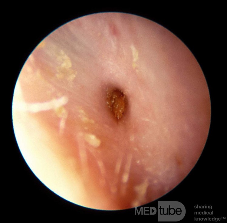 Severe Stenosis of the External Auditory Canal
