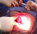Meningocele in an 18-year-old patient