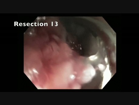 Rectosigmoid Colon Polyp - Giant Polyp Resection