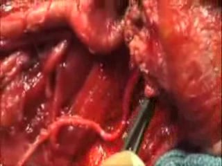 The Trotter Procedure